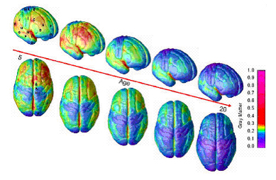 En esta infografía del cerebro, el color rojo indica más materia gris y el color azul menos materia gris.