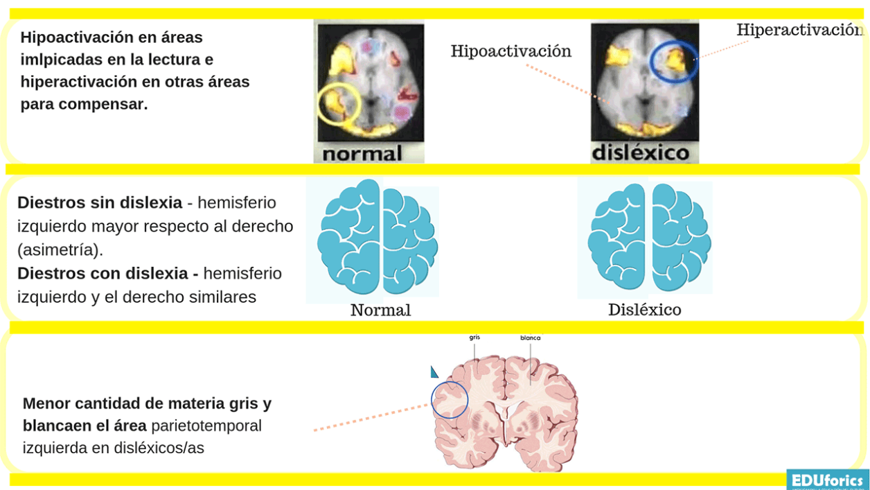 Dislexia. Gráfico del cerebro