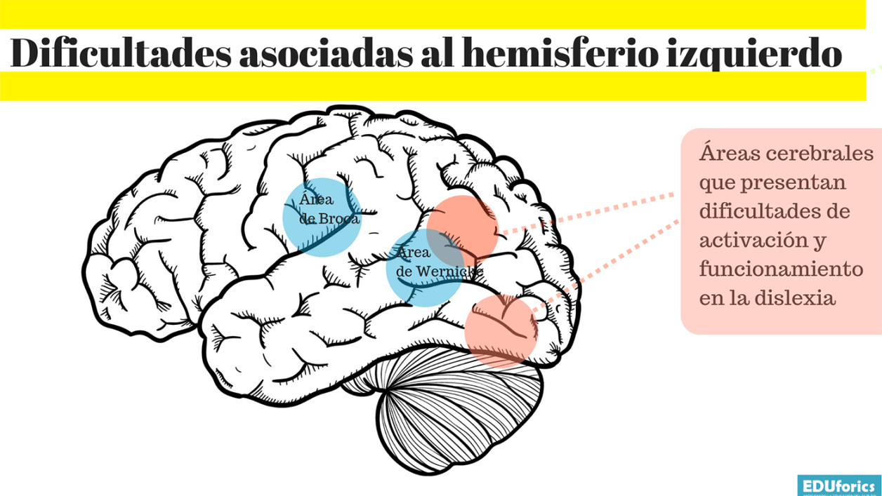 Dificultades asociadas al hemisferio izquierdo del cerebro